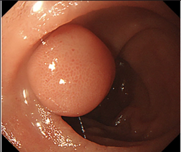 Nang đôi (Duplication Cyst)