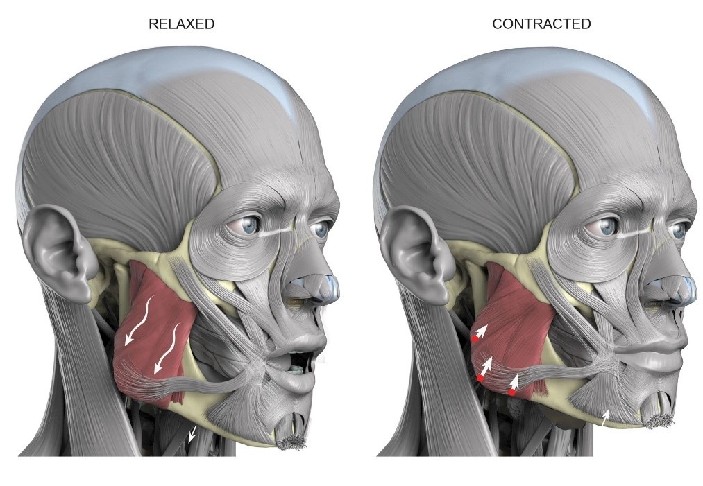 Phì đại cơ nhai (Masticatory muscle hypertrophy)