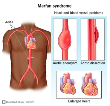 Hội chứng Marfan (Marfan syndrome)