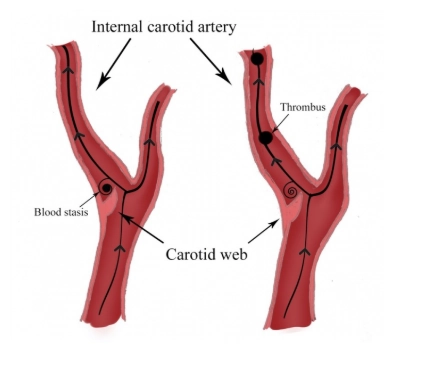 Mạng lưới động mạch cảnh (Carotid web)