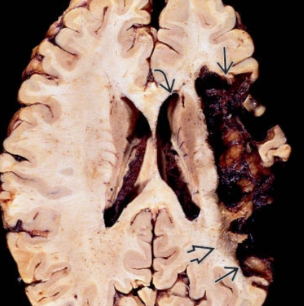 Nhồi máu não giai đoạn mạn tính (Chronic Cerebral Infarction)
