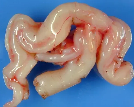 U sợi thần kinh dạng đám rối (Plexiform Neurofibroma - PNF) 