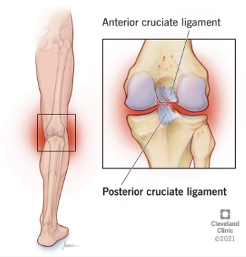 Rách dây chằng chéo sau (Posterior Cruciate Ligament - PCL tear)