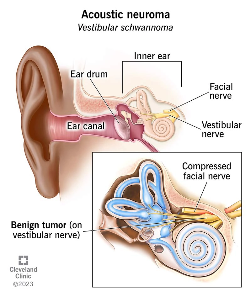Schwannoma tiền đình (Vestibular schwannomas)
