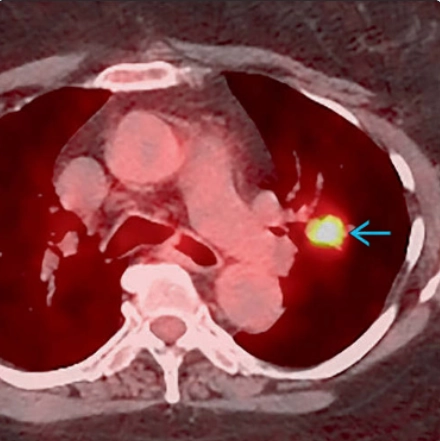 Ung thư biểu mô nhầy- biểu bì phế quản (Mucoepidermoid carcinoma - MEC)