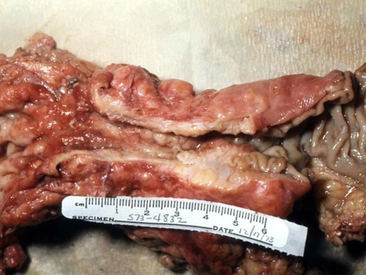 Ung thư đại trực tràng (Colorectal Cancer - CRC)