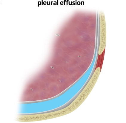 Tràn dịch màng phổi (Pleural effusions)