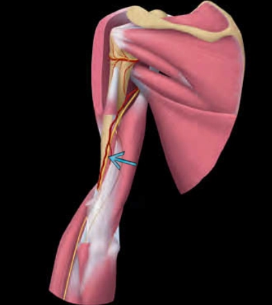 Gãy thân xương cánh tay (Humeral Shaft Fracture)