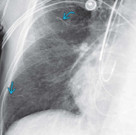 Phù phổi (Pulmonary edema)