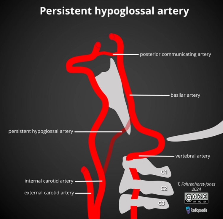 Tồn tại động mạch hạ thiệt (Persistent hypoglossal artery - PHA)