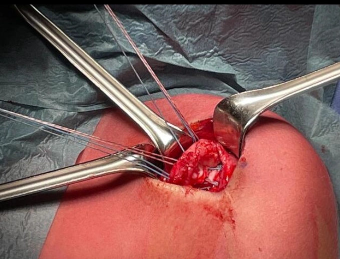 Rách gân cơ dưới vai (Subscapularis tendon tear)