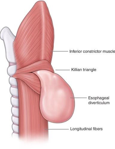 Túi thừa đẩy (Pulsion Diverticulum)
