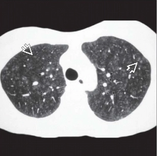 Viêm tiểu phế quản hô hấp (Respiratory Bronchiolitis)