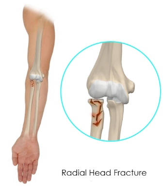 Gãy chỏm xương quay (Radial head fracture)