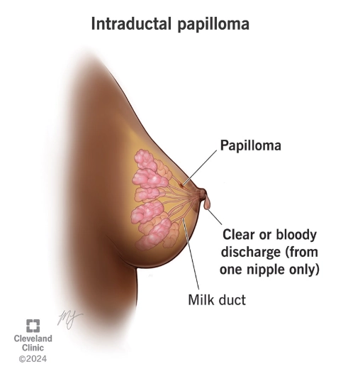 U nhú trong ống tuyến vú (Intraductal papilloma of breast)