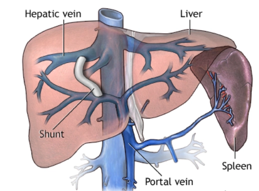 Shunt cửa chủ trong gan qua tĩnh mạch cảnh (Transjugular intrahepatic portosystemic shunt - TIPS/TIPSS)