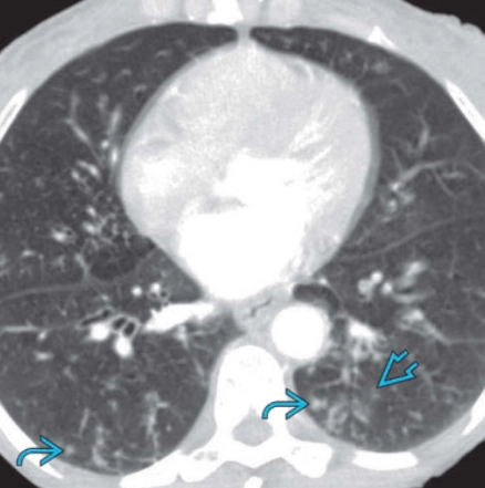 Viêm tiểu phế quản nhiễm trùng (Infectious Bronchiolitis) 