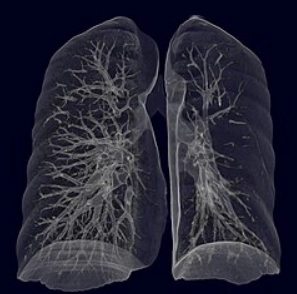 Hội chứng Swyer-James (Swyer-James syndrome)