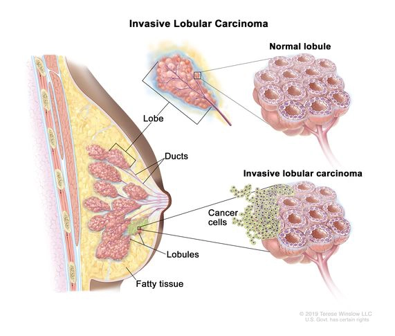 Ung thư biểu mô tiểu thùy xâm nhập của tuyến vú (Invasive lobular carcinoma of the breast)