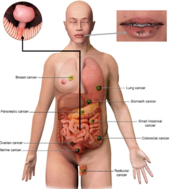 Hội chứng đa polyp Peutz-Jeghers (Peutz-Jeghers syndrome)