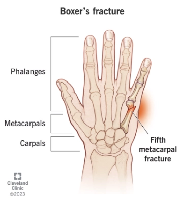 Gãy ngón út xương bàn tay do đấm (Boxer's fracture)