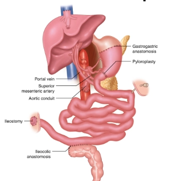 Ghép ruột (Intestinal transplant)