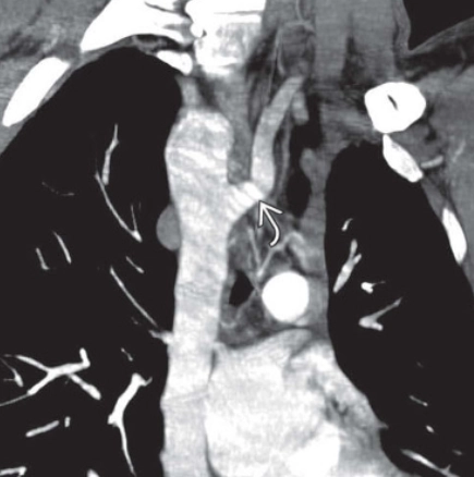 Cung động mạch chủ bên phải (Right-sided aortic arch)