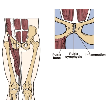 Viêm xương mu (Osteitis pubis)