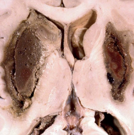 Ngộ độc Methanol (Methanol Poisoning)