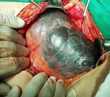 Nang vùi phúc mạc (Peritoneal Inclusion Cyst)