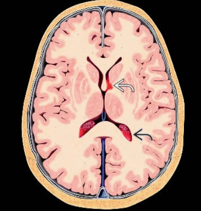 Xuất huyết vùng mầm (Germinal Matrix Hemorrhage - GMH)