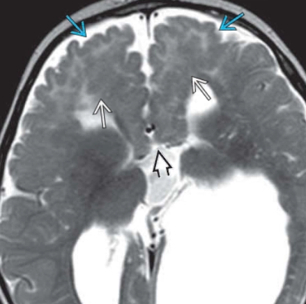 Chất xám lạc chỗ (Grey Matter Heterotopia)