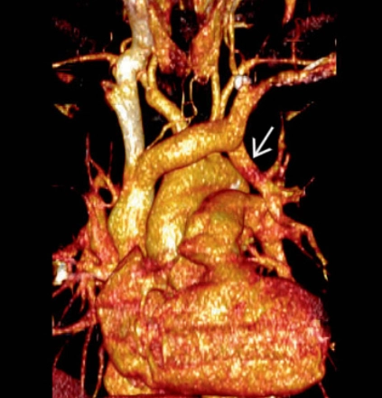 Bất thường hồi lưu tĩnh mạch phổi bán phần (Partial anomalous pulmonary venous return - PAPVR)