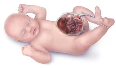Thoát vị rốn thai quý I (Omphalocele)