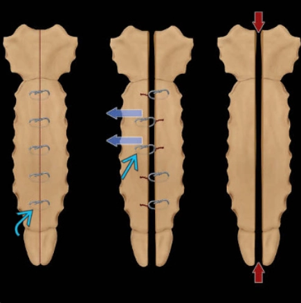 Phẫu thuật mở xương ức - Sternotomy