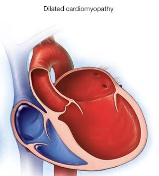 Bệnh cơ tim giãn nở