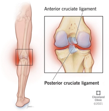 Gãy bong điểm bám dây chằng chéo sau ở xương chày (Posterior cruciate ligament avulsion fracture)