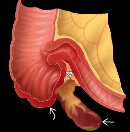 Viêm ruột thừa (Appendicitis (summary))
