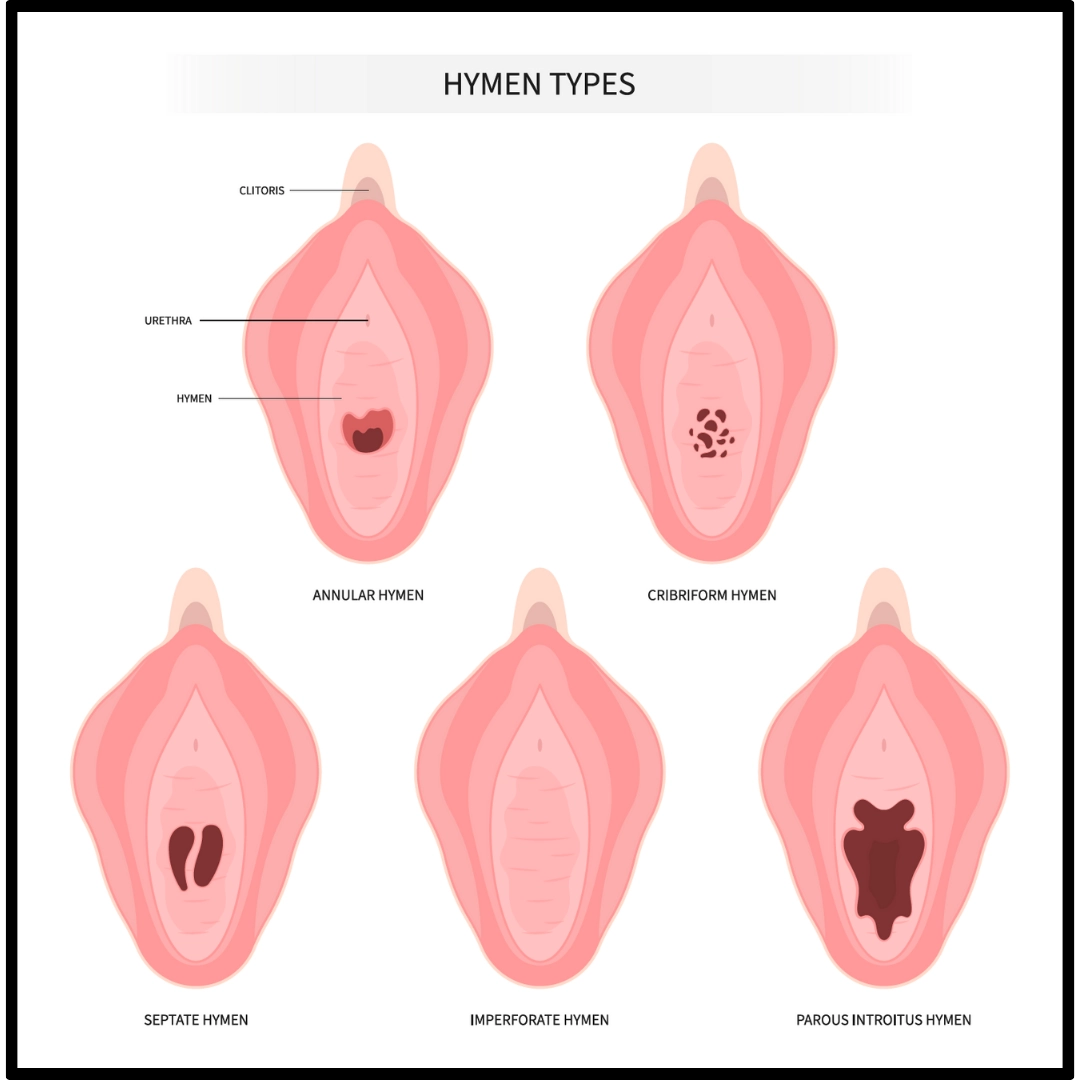 Màng trinh không thủng (Imperforate hymen)