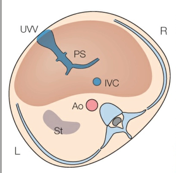 GIÃN TĨNH MẠCH RỐN (UVV)