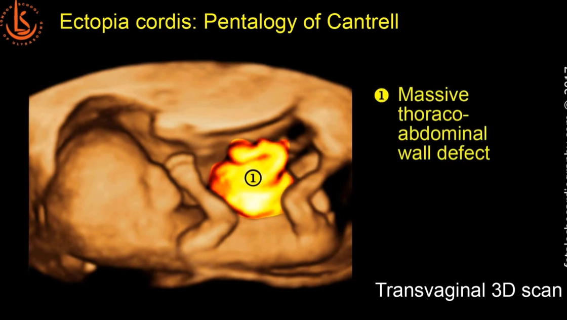 Ngũ chứng Cantrell thai nhi (Pentalogy of Cantrell)