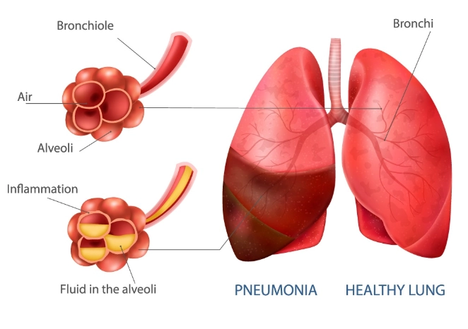 Viêm phổi do Mycoplasma pneumoniae/Viêm phổi không điển hình (atypical pneumonia)