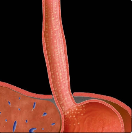 VIÊM THỰC QUẢN CANDIDA (Candida Esophagitis)