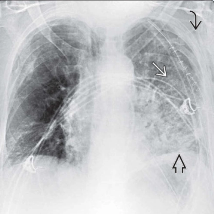 Ghép phổi - Lung transplant