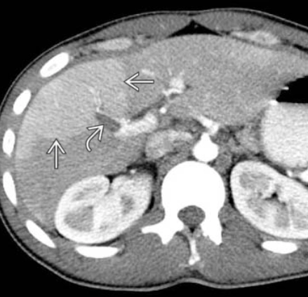 Thay đổi đậm độ gan thoáng qua trên CT (Transient hepatic attenuation differences - THADs)