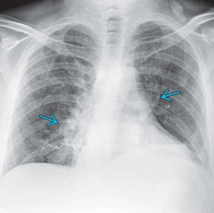 Bệnh phổi do thuốc tiêm (Excipient lung disease - ELD)