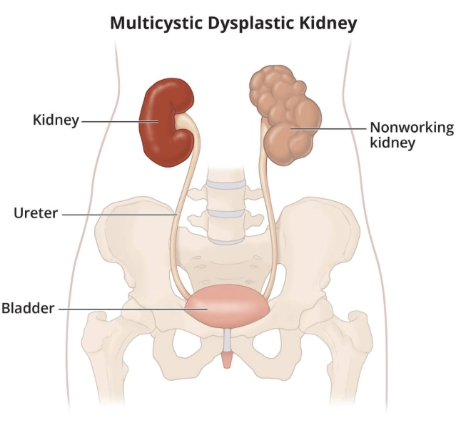 Loạn sản thận đa nang (Multicystic Dysplastic Kidney - MCDK)