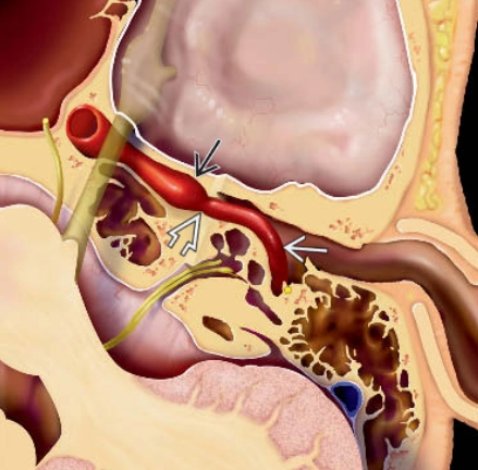 Động mạch cảnh trong lạc chỗ (Aberrant internal carotid artery)