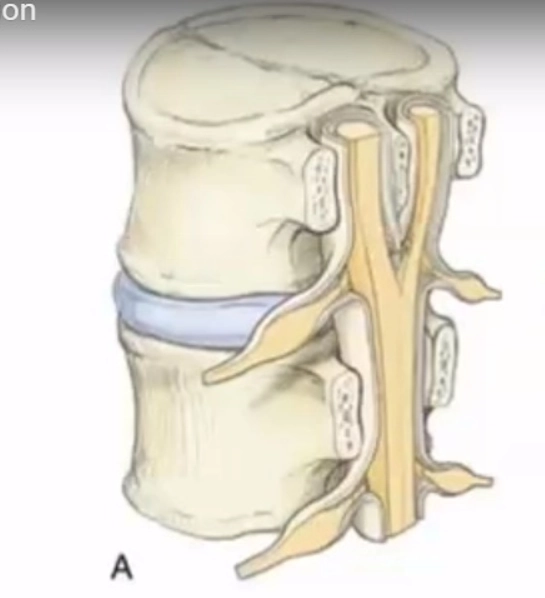 Nứt dọc tủy sống (Diastematomyelia)