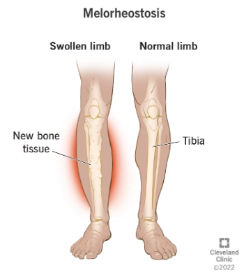 Bệnh xương sáp (Melorheostosis)